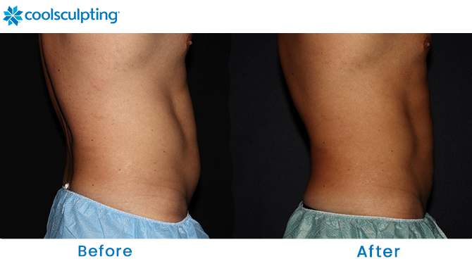 CoolSculpting Male Stomach in Winter Park, Florida
