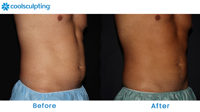 CoolSculpting Male Stomach in Dr. Phillips, Florida
