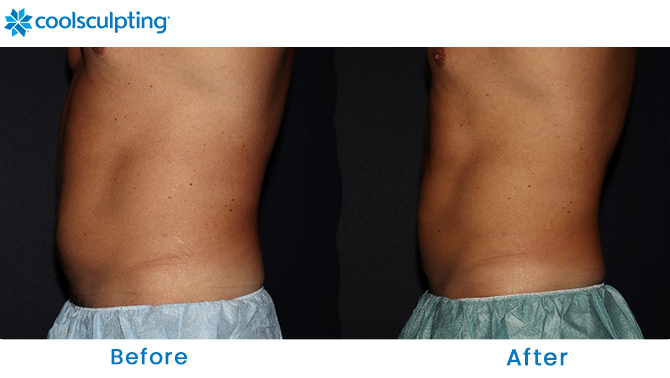 CoolSculpting Male Stomach in Orlando