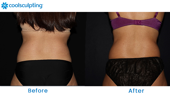 CoolSculpting Flanks in Orlando