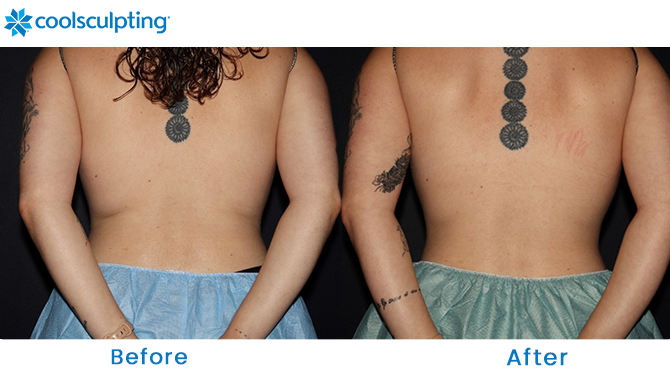 Coolsculpting Before and After Pictures - Female Bra Fat/Back