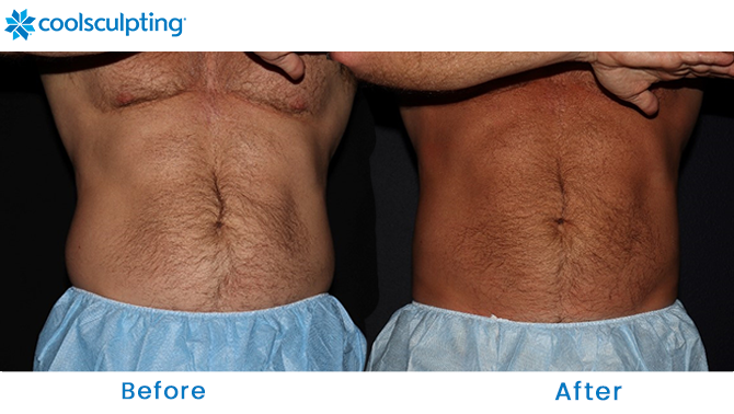 CoolSculpting Male Stomach Dr. Phillips
