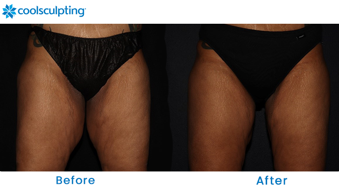 CoolSculpting thighs before and after in Winter Park