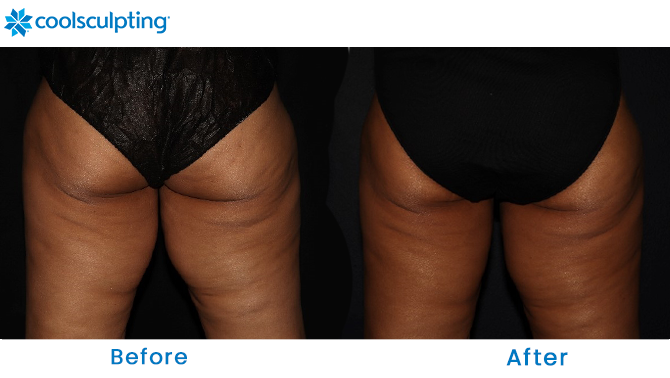 CoolSculpting thighs before and after in Dr. Phillips