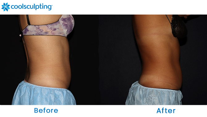 Before and After CoolSculpting Stomach in Orlando, Florida