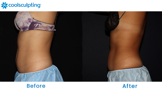 Before and After CoolSculpting Stomach in Winter Park Orlando