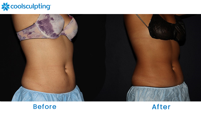 Before and After CoolSculpting Stomach Orlando