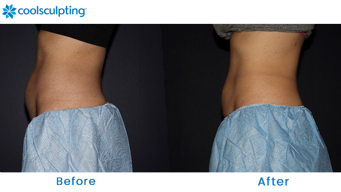 Before and After CoolSculpting Stomach in Winter Park, FL