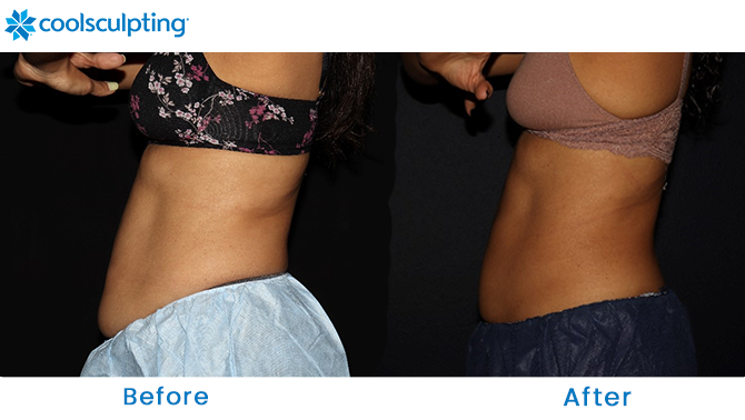 CoolSculpting Before and After Stomach Dr. Phillips, FL