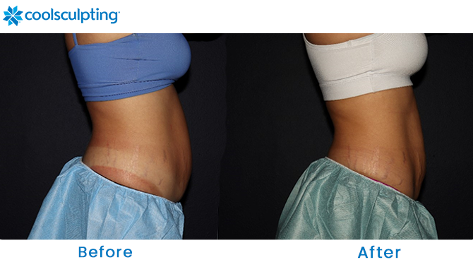 CoolSculpting Before and After Stomach Winter Park, FL