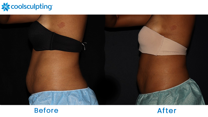Before and After CoolSculpting Stomach Florida