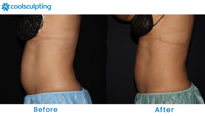 CoolSculpting Before and After Stomach Orlando FL