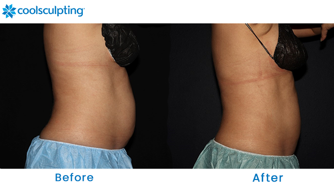 Before and After CoolSculpting Stomach Orlando FL