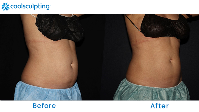 Before and After CoolSculpting Stomach Dr. Phillips  