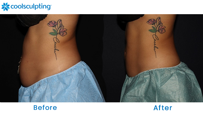CoolSculpting Before and After Stomach