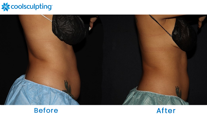Before and After CoolSculpting Stomach in Orlando FL