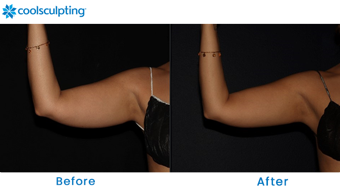 CoolSculpting for Arms Before and After in Winter Park