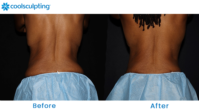 CoolSculpting Bra Fat in Dr. Phillips