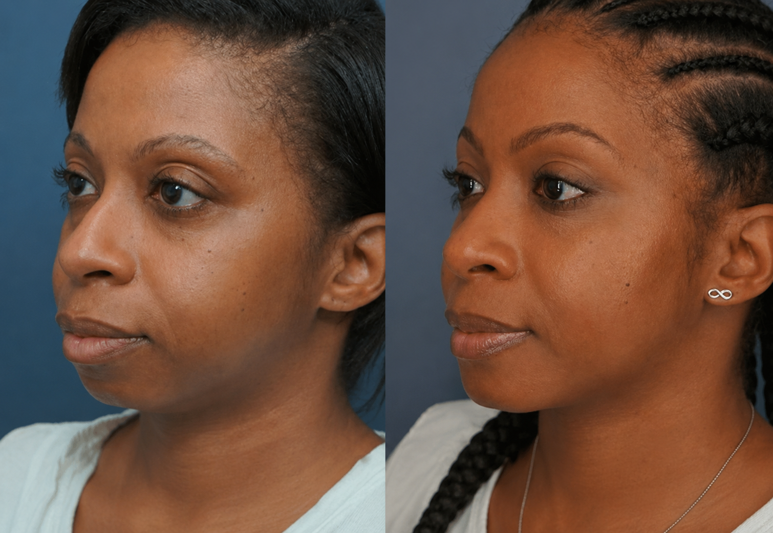 Bodenvy real client before and after 5-Step Renewal skin tightening — full face treatment with subtle, natural-looking results