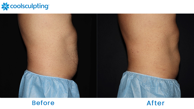 CoolSculpting Male Stomach in Florida