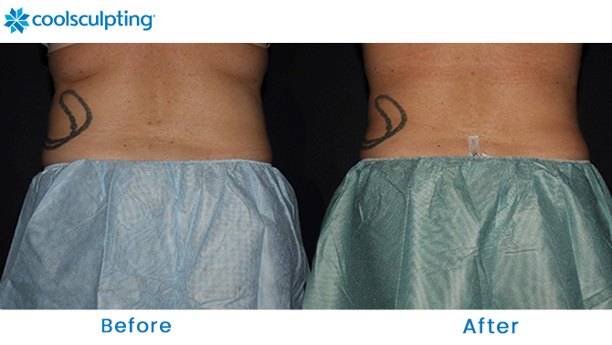 Coolsculpting Before and After Pictures - Female Bra Fat/Back