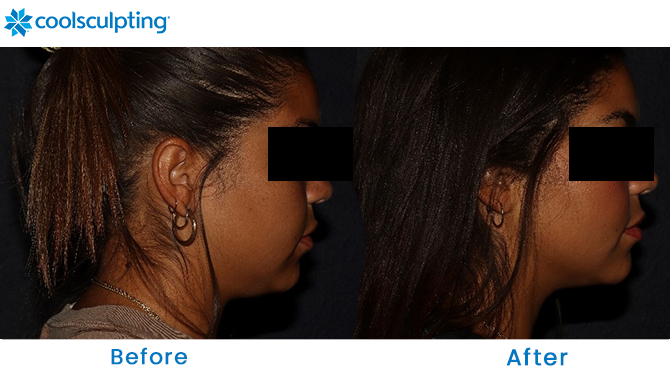 CoolSculpting Chin Before and After in Winter Park