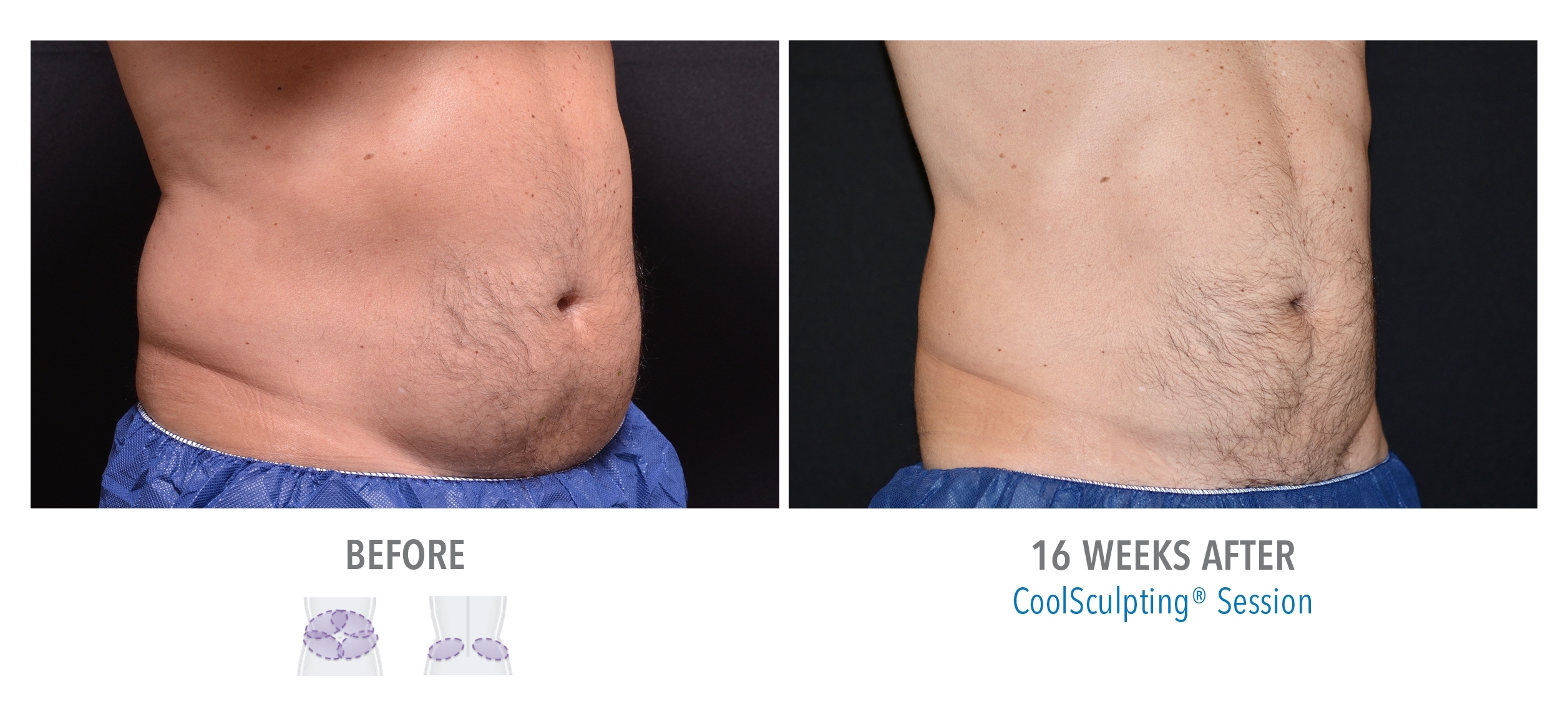Bodenvy Orlando | Get Your CoolSculpting Pricing