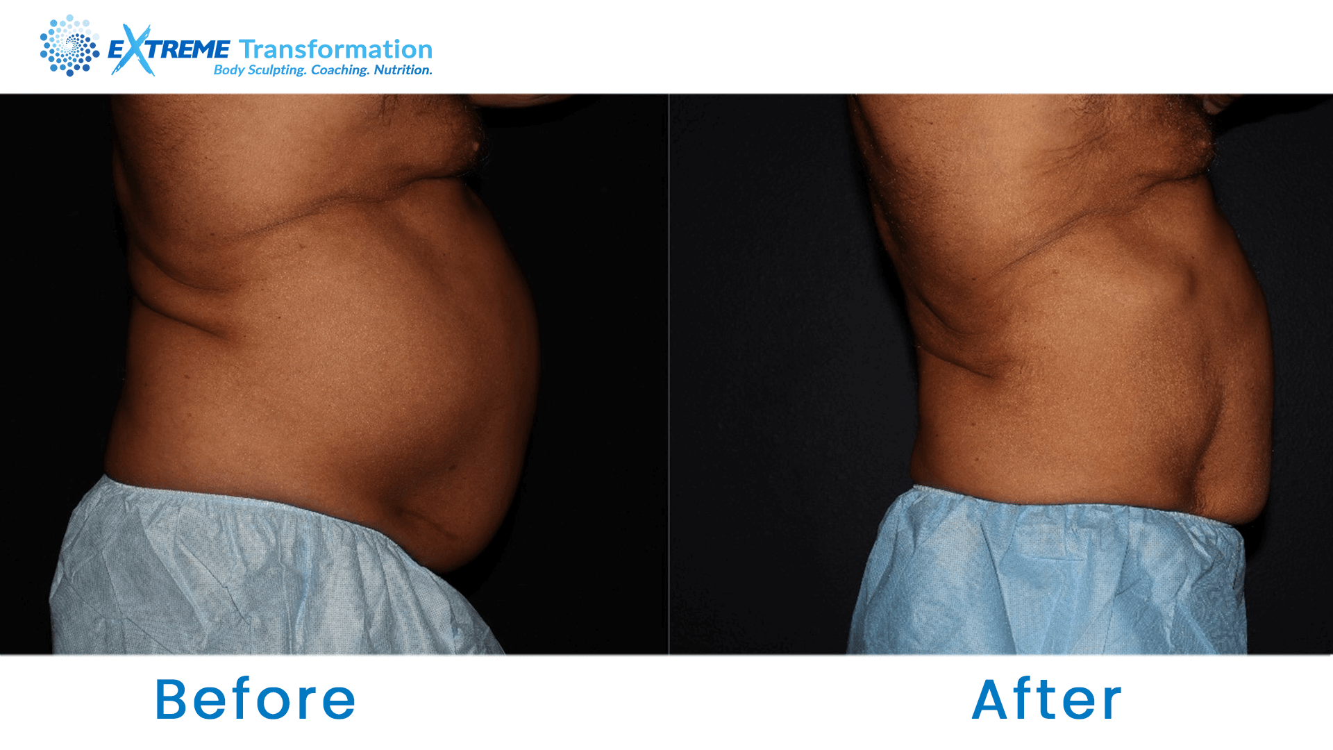 Belly Fat Loss Before and After in Dr. Phillips