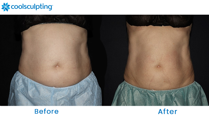 CoolSculpting Before and After Stomach in Orlando FL