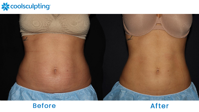 Before and After CoolSculpting Stomach in Orlando