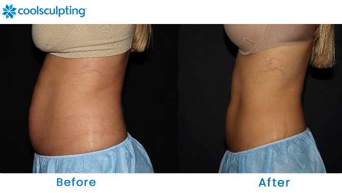 CoolSculpting Before and After Stomach Orlando 