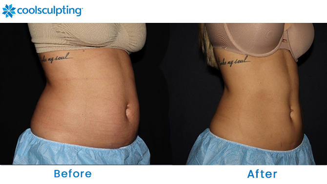 Before and After CoolSculpting Stomach in Dr. Phillips Orlando