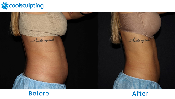Before and After CoolSculpting Stomach in Winter Park