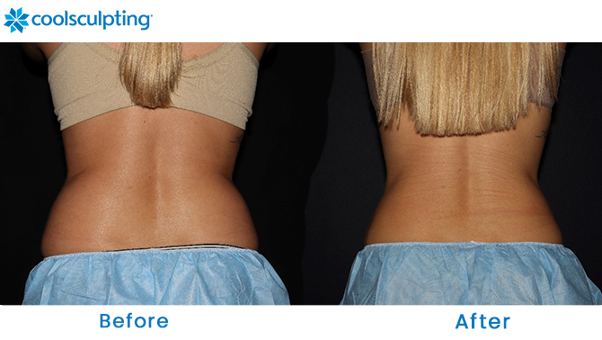 CoolSculpting Bra Fat in Winter Park