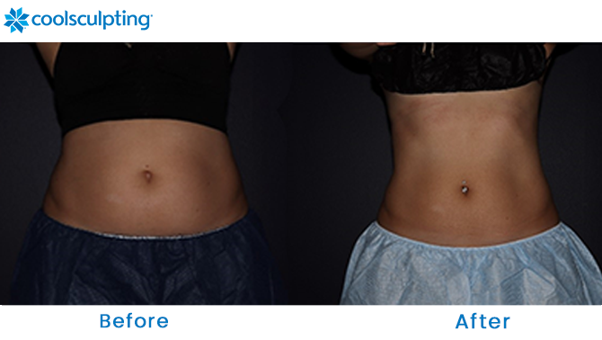 CoolSculpting Flanks in Winter Park