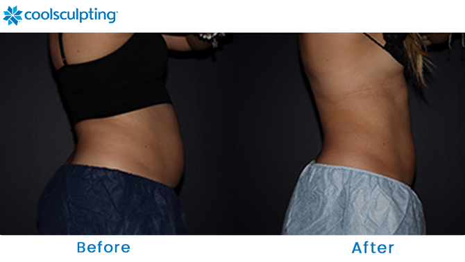 Before and After CoolSculpting Stomach