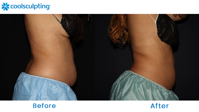 Before and After CoolSculpting Stomach Winter Park Orlando