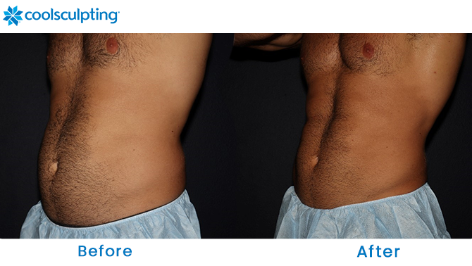 CoolSculpting Male Stomach Winter Park