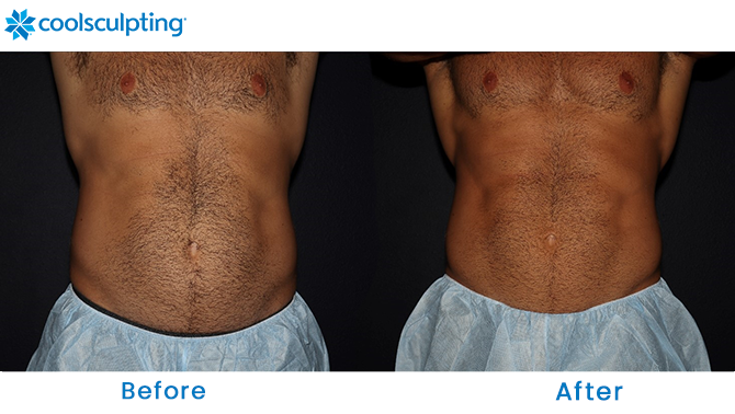 oolSculpting Male Stomach in Winter Park
