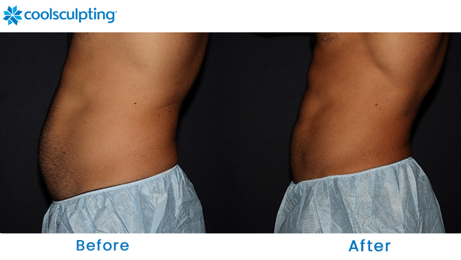 CoolSculpting Male Stomach in Orlando, FL