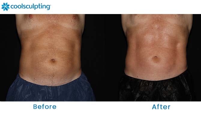 CoolSculpting before and after abs florida