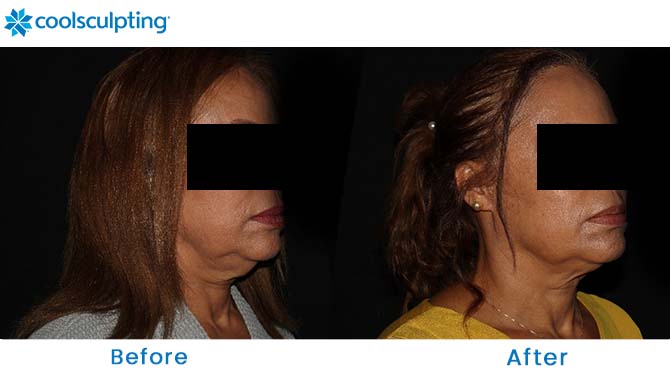 CoolSculpting Chin Before and After