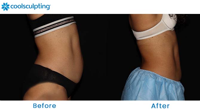 CoolSculpting Before and After Photos Abdomen Dr. Phillips