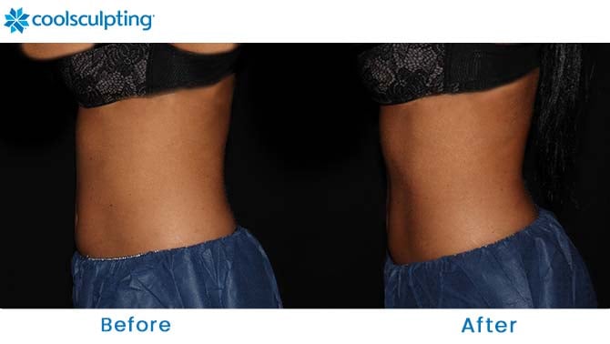 CoolSculpting flanks near me