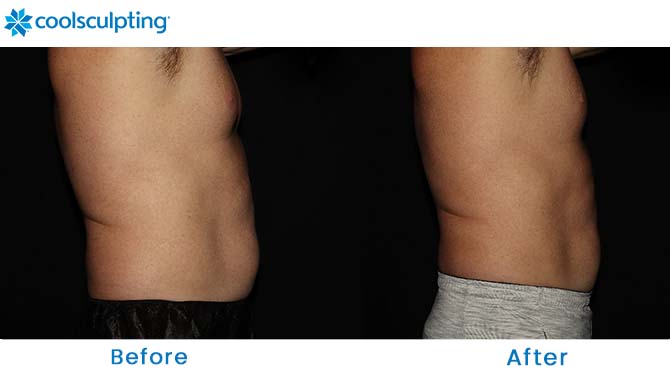CoolSculpting male stomach dr. phillips - orlando