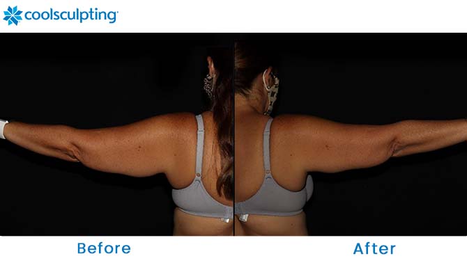 coolsculpting for arms before and after Winter Park FL