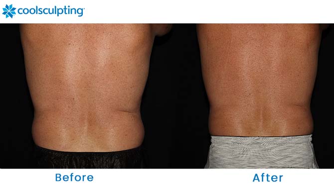 coolsculpting before and after love handles