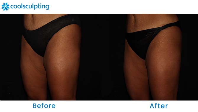 CoolSculpting thighs before and after near me