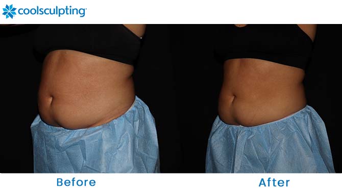 CoolSculpting flanks before and after Orlando 