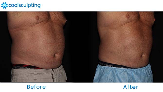 CoolSculpting male stomach 